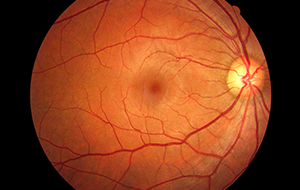 retina-surgery-calgary-SAEC